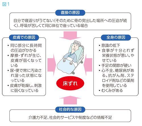 床ずれ、褥瘡のケア